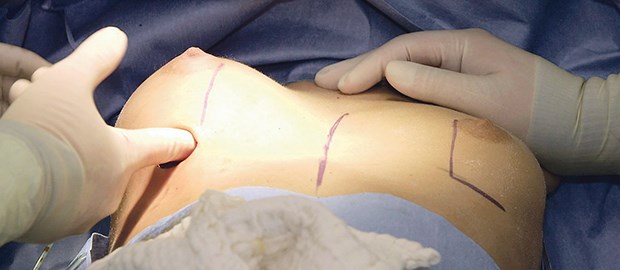 Silikon-Brüste: Ärzte gehen in die Offensive Ein Silikon-Implantat wird eingesetzt.