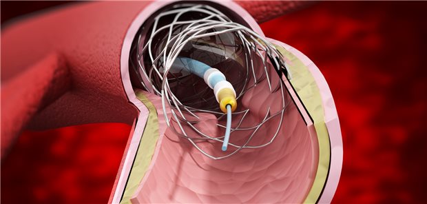 Ein Stent bei einer Karotisstenose? Aus einer Registeranalyse geht hervor, dass die Transkarotis-Revaskularisation ähnlich wirksam und sicher ist wie die Karotisendarteriektomie. (Illustration)