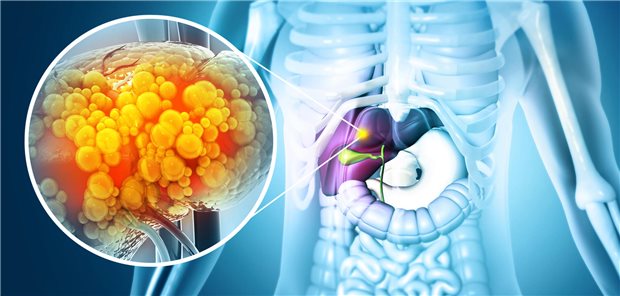 Ein Studienergebnis: Die höchste Chance auf den Rückgang einer zusätzlich vorliegenden nichtalkoholischen Fettleber von Patienten mit Diabetes vom Typ 2 bieten offenbar Gliflozine. (Symbolbild)