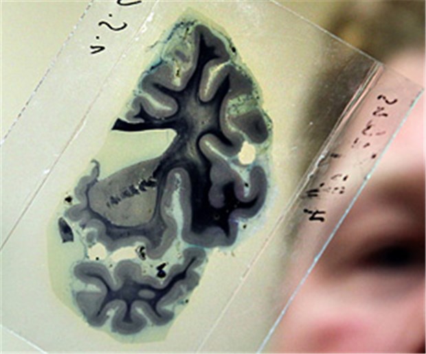 Entzündung bei Alzheimer unter der Lupe Ein Stück Alzheimer: Forscher untersuchen jetzt die Entzündungsprozesse im Gehirn.