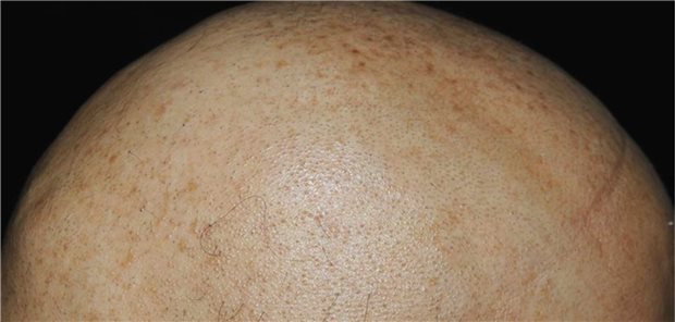 Eine Glatze: Ein Symptom des IFAP-Syndroms ist spärlicher Haarwuchs bis hin zu komplettem Haarverlust.