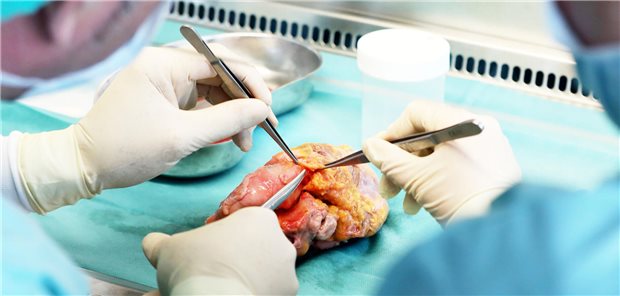 Gewebespende auf Rekordniveau Ein Transplantationsmediziner entnimmt in einer sterilen Werkbank dem Herz eines Verstorbenen die Herzklappen für eine Gewebespende. Bis zu 36 Stunden nach Todeseintritt können Herzklappen noch entnommen werden.