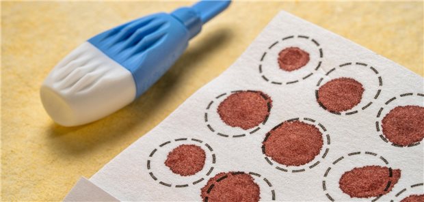 Ein Trockenbluttest kann bei Verdacht auf Morbus Pompe weiterhelfen.