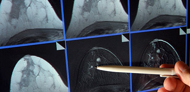 Register werden Realität Ein Tumor ist in einer MRT-Aufnahme einer weiblichen Brust sichtbar. Ziel der Krebsregister ist die Verbesserung der Krebsversorgung.