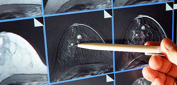 Datenschutz bremst Krebsregister Ein Tumor ist in einer MRT-Aufnahme sichtbar. Die Krebsregister sollen die Krebsvorsorge verbessern.