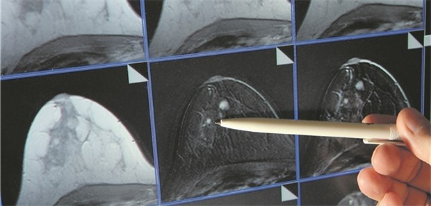 Immunzellen als Marker für die Prognose bei Brustkrebs Ein Tumor ist in einer MRT-Aufnahme sichtbar. Immuntherapien bieten neue Therapiechancen.