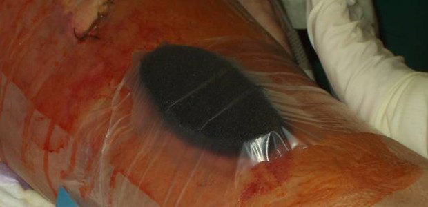 Ein Vorteil der Unterdruck-Wundtherapie: Verbände müssen nicht täglich gewechselt werden.