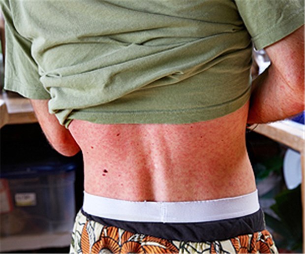 Infizierte wohl wochenlang ansteckend Ein Zika-Patient in Kolumbien mit Hautausschlag.