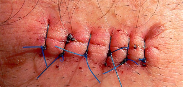 Ein anschließendes optimales Wundmanagement kann eine überschießende Narbenbildung reduzieren.