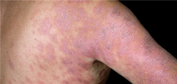 Ein durch eine Arzneimittel-Allergie ausgelöstes Exanthem bei einem 46-jährigen