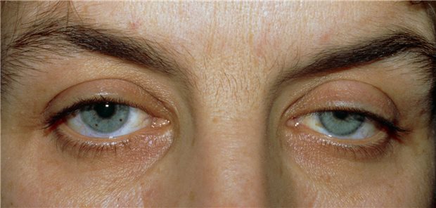 Horner Syndrom mit hängendem Augenlid und kleiner Pupille bei einem jungen Mann.