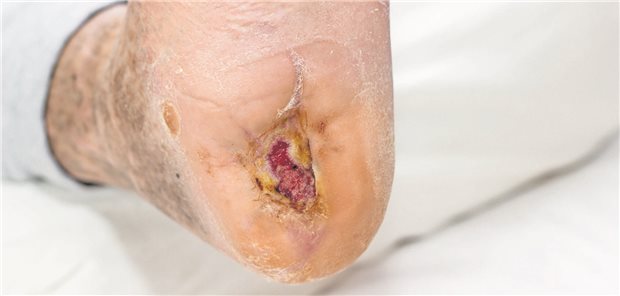 Infektionsrisiko bei Diabetes: Zucker bringt Krankheitserreger in Wallung Ein langjähriger schlecht eingestellter Diabetes kann zu einem diabetischen Fußsyndrom führen.