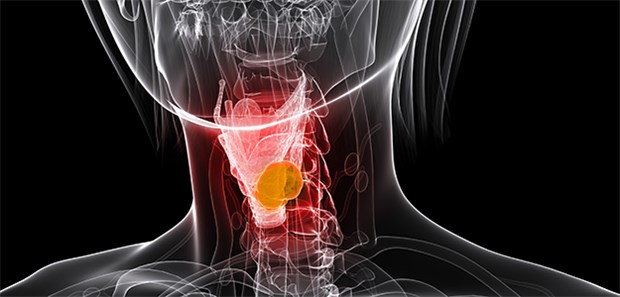 Ein markierter Kehlkopf: Checkpoint-Inhibitoren werden wohl fester Bestandteil der Therapie bei Kopf-Hals-Tumoren.
