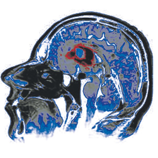 Hirntumoren erfordern differenzierte Behandlungsstrategien Ein mittels Magnetresonanztomografie (MRI) entdecktes Gliom.