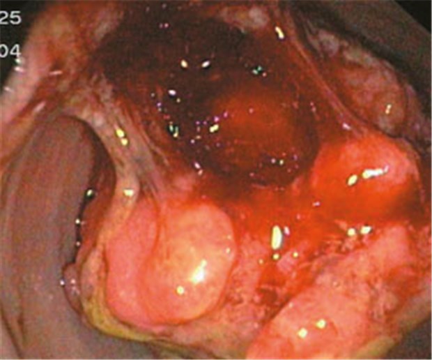 Warten kann sich manchmal lohnen Ein polypöses Rektumkarzinom im Sonogramm: Ist es heutzutage noch gerechtfertigt, jeden von dieser Krankheit betroffenen Patienten bald zu operieren?