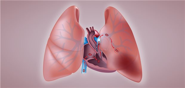 Ein systematisches Screening förderte bei 5,9 Prozent der Patienten mit exazerbierter COPDeine Lungenembolie zutage.
