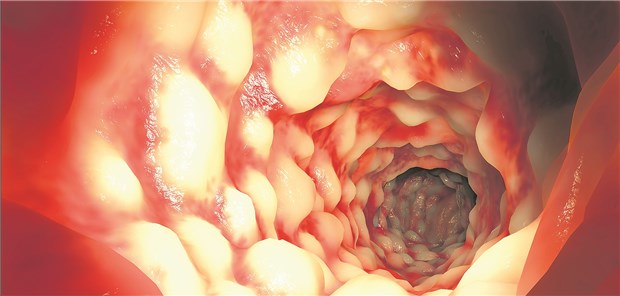 Ein typischer Befund bei Morbus Crohn ist das Pflastersteinrelief der Schleimhaut.