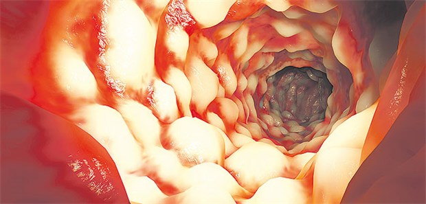 Marker im Stuhl geben Aufschluss über Krankheitsverlauf Ein typischer Befund bei Morbus Crohn ist das Pflastersteinrelief der Schleimhaut.
