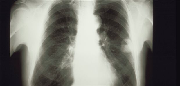 Ein wandnahes Bronchialkarzinom.