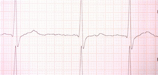Ein zufällig entdecktes Vorhofflimmern sollte bei Patienten genauso behandelt werden wie ein symptomatisches, schreiben die Autoren einer Studie.