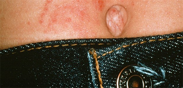 Wo Nickel im Alltag noch so steckt Eine Allergie ausgelöst durch einen Hosenknopf: Schwedische Forscher meinen, dass Nickel in mehr Alltagsdingen als gedacht steckt.