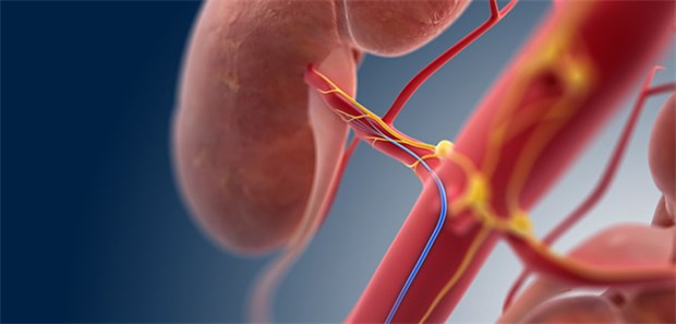 Totgesagte leben länger Eine Art der renalen Denervation: Viele Experten wollen die Methode weiter erforschen.