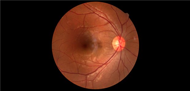 Medizinische Netzhautanomalie bei diabetischer Retinopathie, isoliert auf schwarzem Hintergrund.