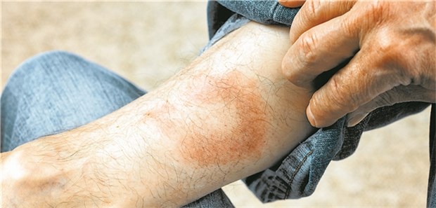 Positiver Titer noch kein Borreliose-Beweis Eine Borrelien-Infektion manifestiert sich primär in Form eines Erythema migrans.
