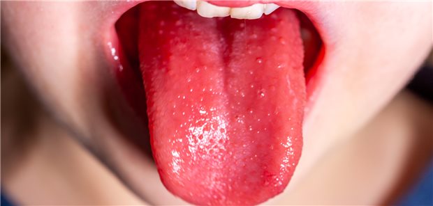 Eine Erdbeerzunge: Typisches Merkmal einer Scharlach-Infektion.