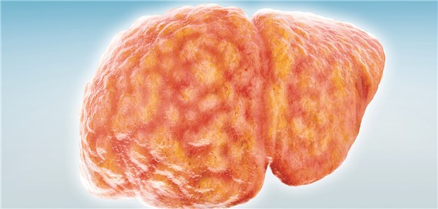 Eine Fettleber – die Fettdepots sind gut zu erkennen.