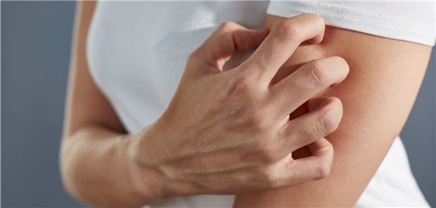 Eine Frau kratzt sich, weil die Haut juckt. Kratzen bei chronischem Pruritus ist typisch für ekzematöse Erkrankungen.