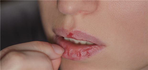 Eine Frau zupft sich Haut von der Lippe ab.