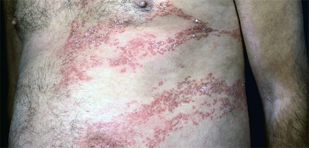 Eine Gürtelrose kann sehr schmerzhaft für die Betroffenen sein.