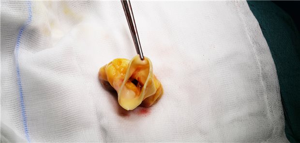 Gewebespenden: Mangel an gespendeten Herzklappen immer größer Eine Herzklappe aus einer Gewebespende. Trotz Ausbaus der Gewebespende verzeichnet die DGFG in 2022 einen starken Rückgang in der Spende von Herzklappen.