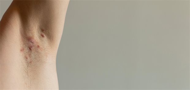 Eine Hidradenitis suppurativa schädigt nicht nur die Haut in Bereichen wie Achselhöhlen.