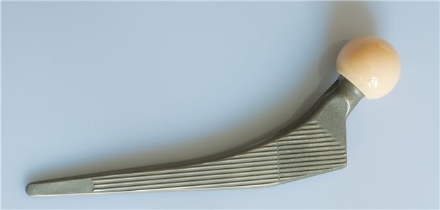 Metallabscheidung einer Hüftprothese führt zu Schadenersatz Eine Hüftprothese: Zu viel Metall sollte nicht in den Körper abgegeben werden, so eine Entscheidung des OLG Karlsruhe. (Symbolbild)
