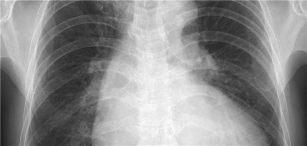 Eine Kardiomegalie (hier auf einer Röntgenaufnahme) kommt oft im weiteren Verlauf von Morbus Pompe vor.
