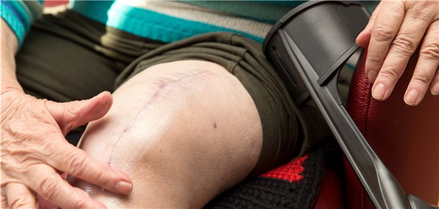 Eine Knie-TEP lindert zwar häufig die Schmerzen, senkt aber nicht unbedingt die Sturzrate.