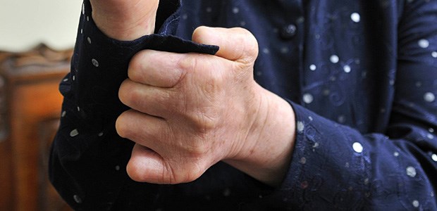 Ein Kampf gegen Seuche und Stigma Eine Lepra-Patientin, 72 Jahre alt, aus Bogota in Kolumbien schließt mit verstümmelten Händen den Knopf ihrer Bluse.