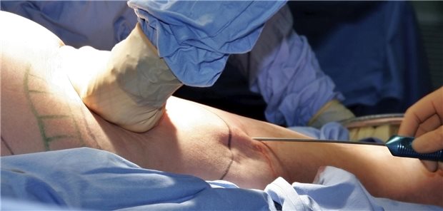 Eine Liposuktion kann durchaus in mehreren Schritten an mehreren Extremitäten getrennt erfolgen, so der BGH.