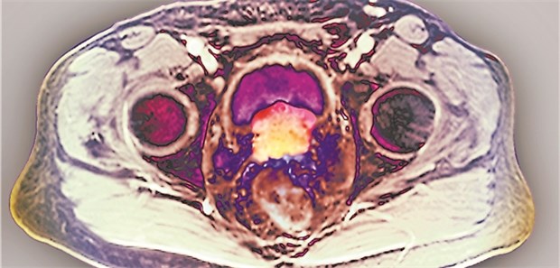 Spitzendiagnostik made in Germany Eine MRT-Aufnahme des Unterbauchs eines 74-jährigen Patienten mit Prostata-Ca.