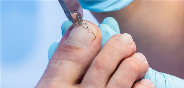 Nagelspange: eine Alternative zur Operation Eine Nagelspangenbehandlung ist eine Alternative zu ärztlich-konservativen und chirurgischen Maßnahmen.
