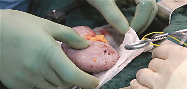 Mit Zelltherapie weniger Immunsuppressiva nötig Eine Niere wird zur Transplantation vorbereitet. Werden die Organempfänger künftig im Anschluss an die Op auch mit einer Zelltherapie behandelt?