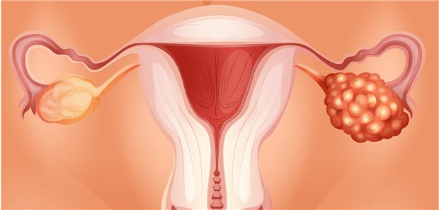 Eine PID in der Vorgeschichte war in einer Studie mit einem erhöhten Risiko für ein epitheliales Ovarialkarzinom verbunden. Bisher ist unklar, ob die krebserregende Wirkung eines bestimmten Erregers oder der Entzündungsprozess selbst das Risiko erhöhen.