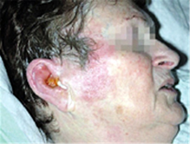 Wenn sich pathogene Erreger im Gehörgang breit machen Eine Patientin mit Otitis externa - die Entzündung hat auf angrenzende Hautbezirke übergegriffen.