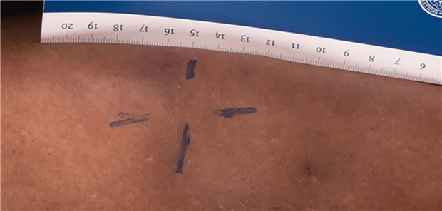 Eine Patientin stellte sich bei den Autoren mit einer erhabenen Verhärtung am Unterschenkel vor. Weitere Symptome waren Schmerzen, Juckreiz und Brennen.