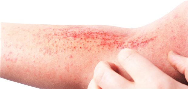 Eine Person kratzt eine gerötete Hautstelle. 