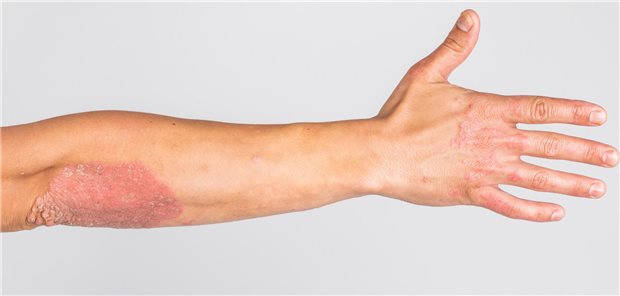 Eine ausgestreckte Hand mit Schuppenflechte