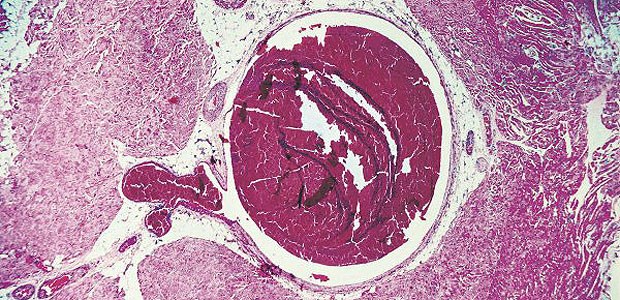 Erhöhtes Thromboserisiko hält lange an Eine RA ist mit einem erhöhten Risiko für venöse Thrombosen assoziiert.