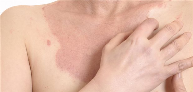 Eine RRD sollte in Betracht gezogen werden, wenn sich Erytheme an einer zuvor bestrahlten Stelle entwickeln. Die Strahlentherapie bei Brustkrebs sei der häufigste Auslöser, so die Ärztinnen und Ärzte um Rajeh. Ein charakteristisches Merkmal von RRD sei ein geometrisches Erscheinungsbild mit scharfen, gut definierten Rändern, die bei primären Dermatosen normalerweise nicht zu sehen seien.